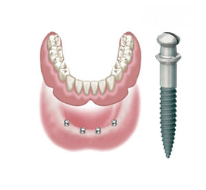 Konisches Zahnimplantat - ATLAS  - DENTATUS AB   - Titan / mit Außenverbindung / one step