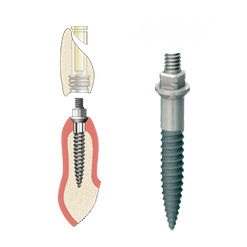 Konisches Zahnimplantat - ANEW  - DENTATUS AB   - Titan / mit Außenverbindung / schmal