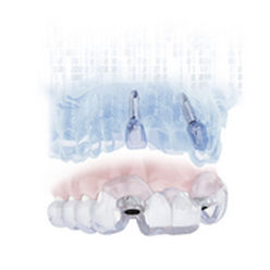 Software / dental- implantologische Planung - SIMPLANT® - DENTSPLY Implants GmbH - Planung / für Dentalimplantologie