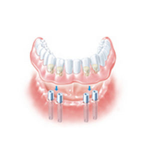 Gerades Implantat-Abutment - ANKYLOS® SynCone® - DENTSPLY Implants GmbH