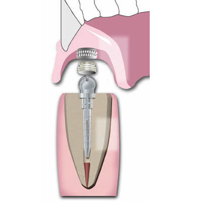 Metallwurzelstift - Flexi-Overdenture - ESSENTIAL DENTAL SYSTEMS  