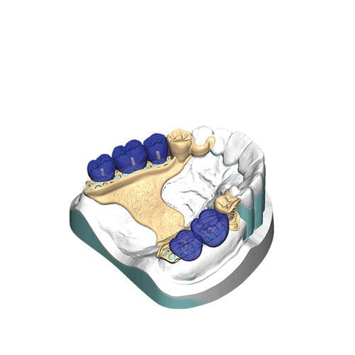 Software-Modul / Projektentwicklung - PartialCAD - exocad GmbH   - Druck / für Dentallabor / Gebiss