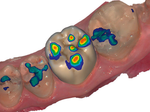 Software-Modul / Erfassung - Auto Articulator  - exocad GmbH   - Projektentwicklung / Dental / Dental