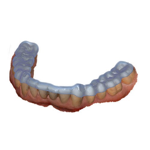 Software-Modul / Projektentwicklung - Bite Splint - exocad GmbH   - Dental / Gelenk