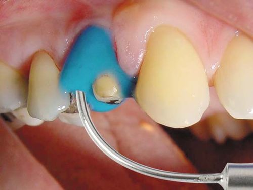 Zahnmedizinisches Material / Alginat - Algiloid® - Hager & Werken - für Zahnbrücken / für Dentalkronen / für Dentalinlays