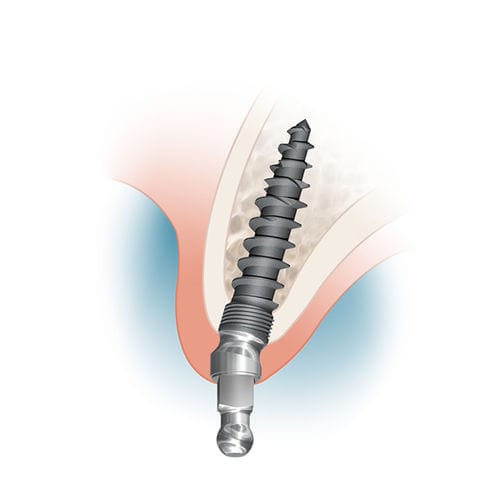 Titan-Zahnimplantat - MDL2513A, MDL2515A, MDL2518A - Intra-Lock International, Inc.   - Kugel / gewinkelt