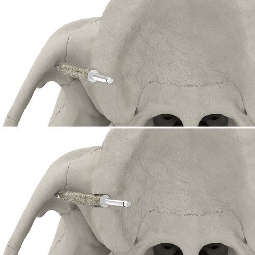 Bohrer für Implantatosteotomie - JDZygoArch  - JDENTALCARE SRL   - Diamant