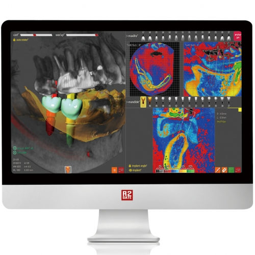 Planungssoftware - R2GATE - Megagen Implant - dental- implantologische Planung / FAO / für Zahnprothese-Design