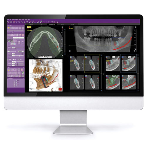 Bildanalyse-Software - iRYS - MyRay - Viewer / Diagnose / Planung