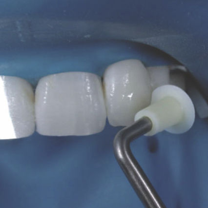 Modellierinstrument für Dentalkomposit - NA067 - Navadha Enterprises  