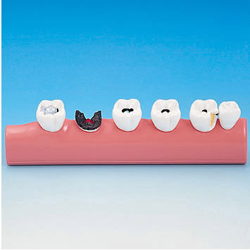 Anatomisches Modell / Dental - PE-TDS005 - Nissin Dental Products Inc.   - für die Ausbildung / Karies