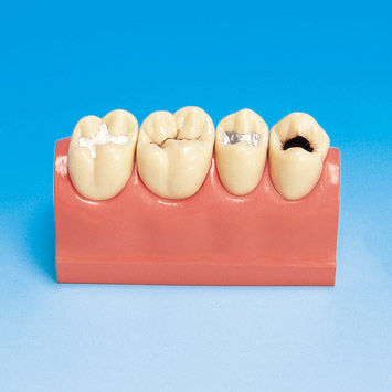 Anatomisches Modell / Dental - PE-STP007 - Nissin Dental Products Inc.   - für die Ausbildung / Karies