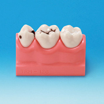 Anatomisches Modell / Dental - PE-STP008 - Nissin Dental Products Inc.   - für die Ausbildung / Karies