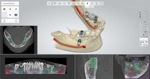Planungssoftware - Thommen Medical AG   - für geführte Chirurgie / für Dentalimplantologie