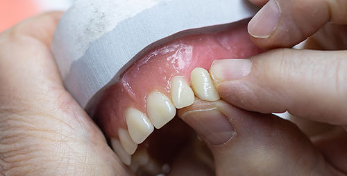 Verbundwerkstoff-Zahnprothese - VITAPAN®  - VITA Zahnfabrik H. Rauter GmbH & Co.KG   - für Vorderzähne