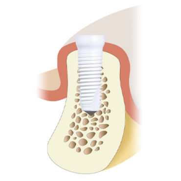 Zylindrisches Zahnimplantat - Z5-TL - Z-Systems AG   - Keramik / mit Innenverbindung / gerade