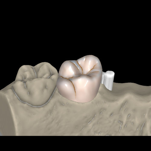 Software-Modul / für Dentallabor - Attachments - Zirkonzahn - CAD / FAO / zur Prothesenherstellung