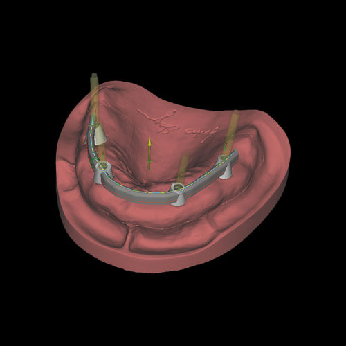 Software-Modul / CAD - Bars - Zirkonzahn - für Zahnprothese-Design / FAO / für Dentallabor