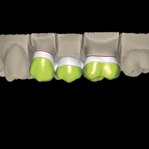 Software-Modul / CAD - Overpress crowns and overpress bridges - Zirkonzahn - für Zahnprothese-Design / FAO / für Dentallabor