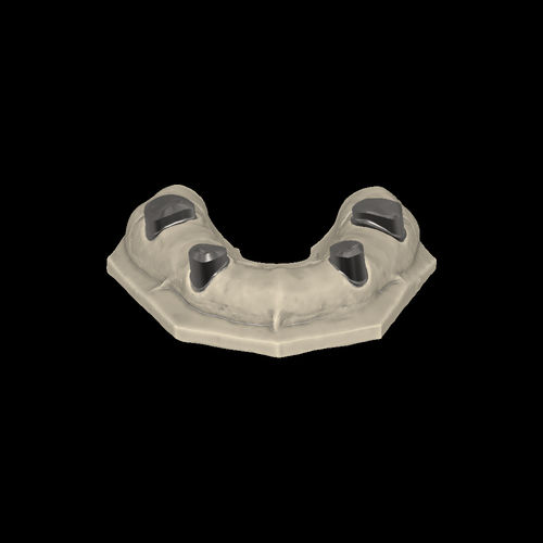Software-Modul / für Dentallabor - Telescopic crowns - Zirkonzahn - CAD / für Zahnprothese-Design / FAO