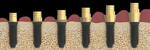 Implantat-Abutment / Spiral - K80  - Zirkonzahn - Titan / konisch / mit Innenverbindung