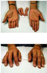 Kosmetische Fingerprothese - Boston Orthotics + Prosthetics - Teil / für Erwachsene