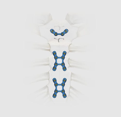 Kompressionsplatte für Brustbein - SternaLock® Blu - Zimmer Biomet - mit Verriegelung / Titan