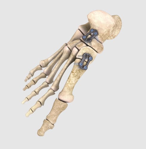Kompressionsplatte für Vorfuß - A.L.P.S.® - Zimmer Biomet - für Rückfuß / mit Verriegelung / ohne Verriegelung