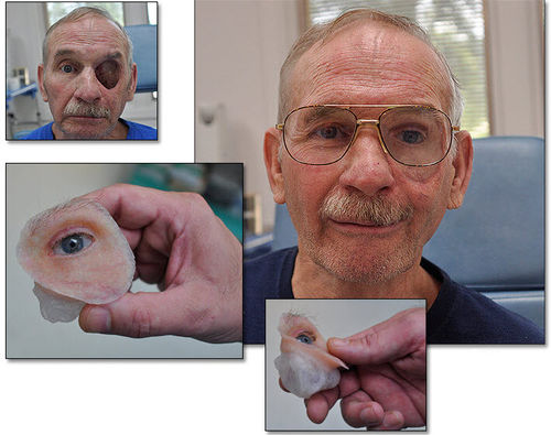 Kosmetische Prothese für eine Gesichtshälfte - RealLifeSkin™ - RealLifeSkin - Orbital / für Erwachsene