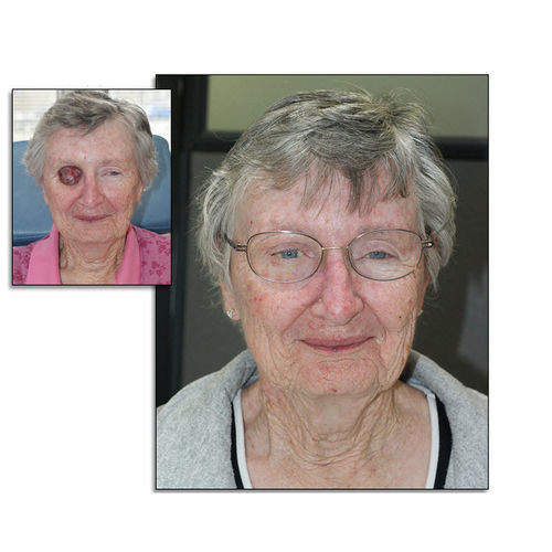 Kosmetische Orbitalprothese - RealLifeSkin™ - RealLifeSkin - für Erwachsene