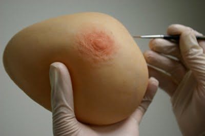 Kosmetische Brustprothese - The Anaplastology Clinic - für Erwachsene