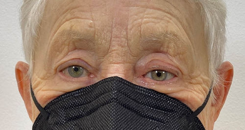 Kosmetische Augenprothese - Scleral Shells - The Anaplastology Clinic - für Erwachsene
