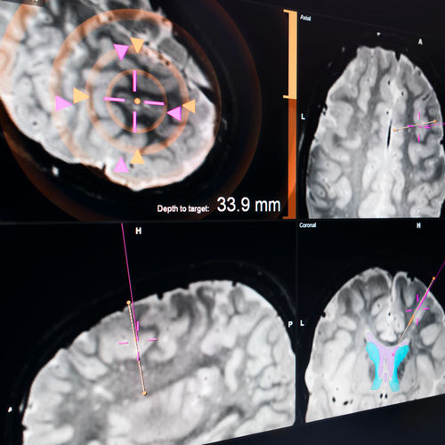 Software für Krankenhaus - EM - Brainlab - für Neurochirurgie / Steuerung / Kalibrierung