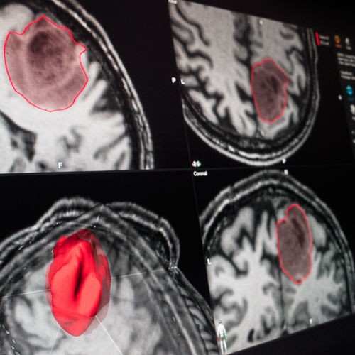 Visualisierungssoftware - Brainlab - Planung / Umform / Kantendetektion