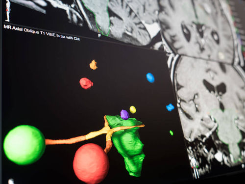 Visualisierungssoftware - Brainlab - Präoperative Planung / Behandlungsplanung / Umform