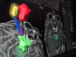 Planungssoftware - Brainlab - Import / Bewertung / Interpretation