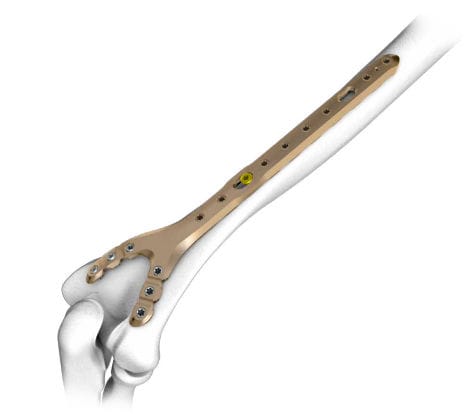 Kompressionsplatte für Humerus - 3.7243.6 series - ChM - distal / mit Verriegelung / Metall