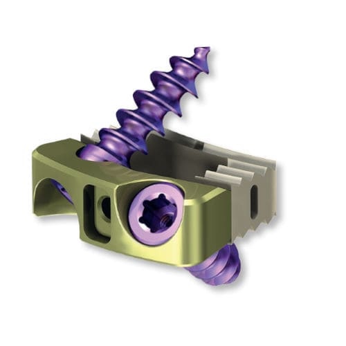 HWS-Zwischenwirbelimplantat - 8.6970.505 - ChM - ventraler Zugang / aus PEEK / Titan