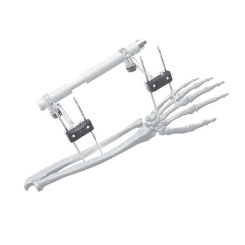Fixateur externe / für Handgelenk - 206315 - SOFEMED International - rohrförmig / für Erwachsene