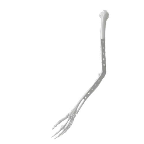 Arthrodeseplatte für Ellbogen - SM16005 - SOFEMED International - mit Verriegelung / Titan