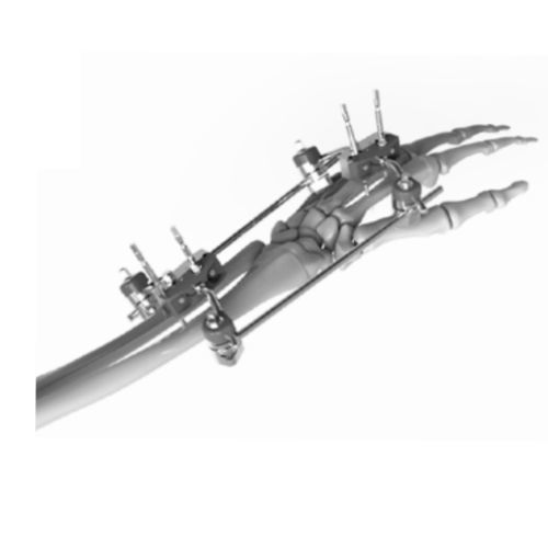 Fixateur externe / für Handgelenk - 206301 - SOFEMED International - rohrförmig / für Erwachsene