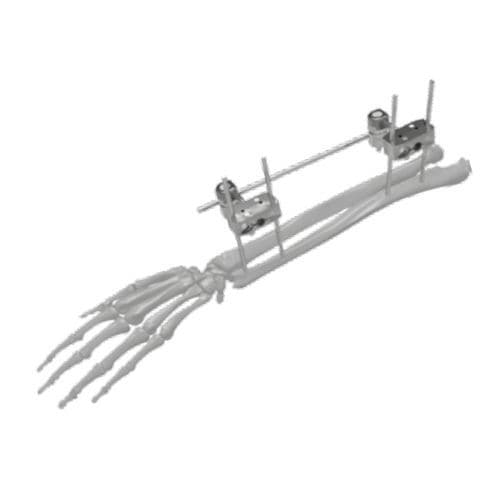 Fixateur externe / für Ulna - 206302 - SOFEMED International - für Radius / rohrförmig / für Erwachsene