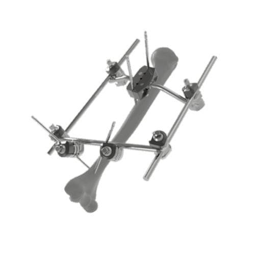 Fixateur externe / für Humerus - 206305 - SOFEMED International - rohrförmig / für Erwachsene