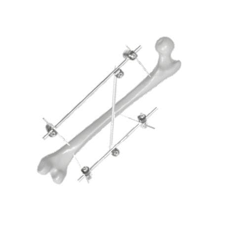 Fixateur externe / für Oberschenkelknochen - 206307 - SOFEMED International - rohrförmig / für Erwachsene