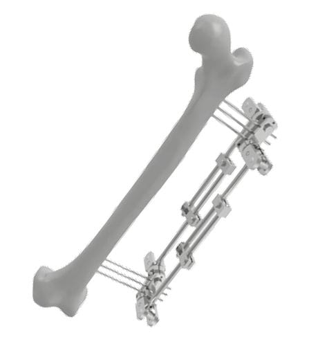 Fixateur externe / für Oberschenkelknochen - 201502 - SOFEMED International - rohrförmig / für Erwachsene