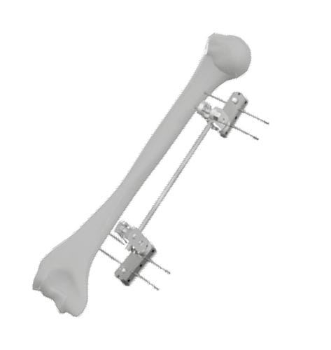 Fixateur externe / für Humerus - 201541 - SOFEMED International - rohrförmig / für Erwachsene