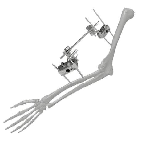 Fixateur externe / für Ellbogen - 206303 - SOFEMED International - rohrförmig / für Erwachsene