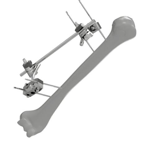 Fixateur externe / für Humerus - 206304 - SOFEMED International - rohrförmig / für Erwachsene