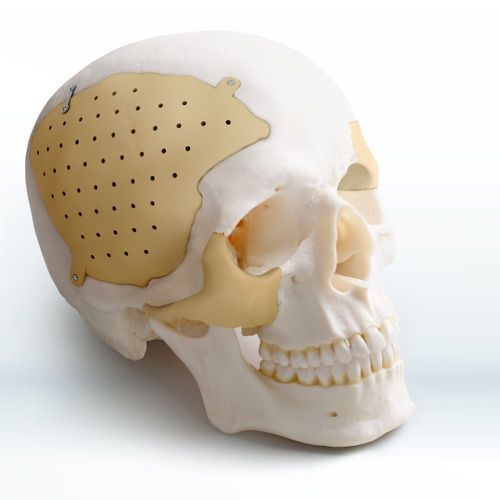 Patientenspezifisches Schädelimplantat - Recranio™ - Medprin Biotech