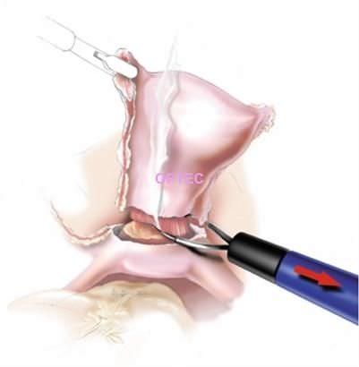 Laparoskopische Elektrode - LapLoop  - OPTEC Endoscopy Systems - Schlaufen / monopolar